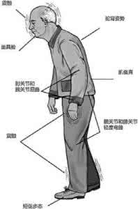 老年性震颤的治疗方法 老年性震颤