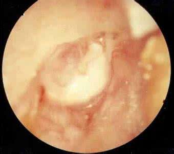 中耳炎治疗方法 中耳炎的治疗方法 治中耳炎可用这八种方法