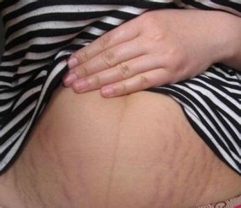 偏方去妊娠纹小窍门 去妊娠纹最好的偏方 去妊娠纹偏方