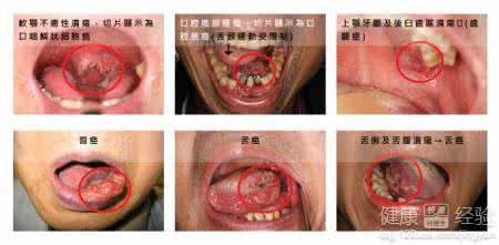 口腔癌饮食 医治口腔癌 饮食很主要