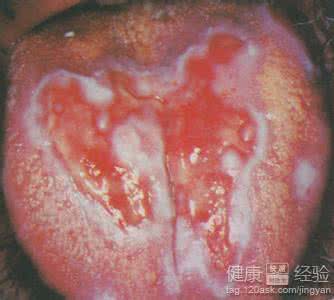 口腔扁平苔藓怎么治 古方论治口腔扁平苔藓