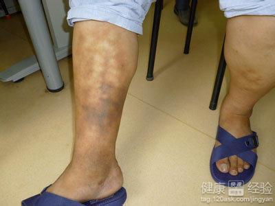 深静脉血栓怎么治疗 静脉血栓 怎么治疗静脉血栓