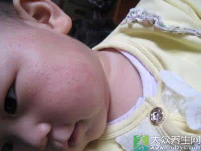 宝宝湿疹怎么护理 宝宝湿疹怎么护理 宝宝患湿疹怎样治疗和护理？