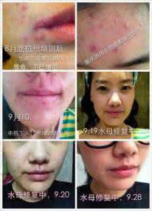 青春痘痘疤痕 痘痘疤痕修复方法 青春痘痘疤可以修复吗？