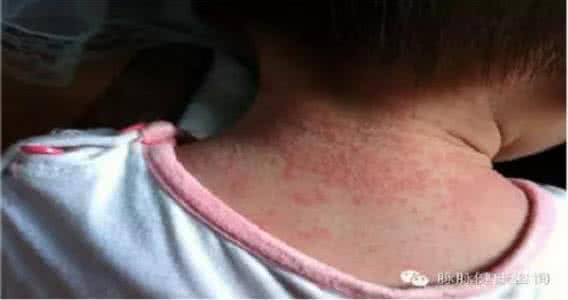 孩子热痱子 天热了，孩子身上容易长痱子，只要用它百试百灵