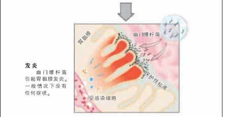 有幽门螺杆菌的症状 胃里的“幽门螺杆菌”什么时候必须清除？