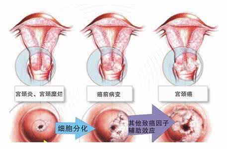 宫颈糜烂有什么危害 宫颈糜烂有什么危害吗 宫颈糜烂危害有哪些