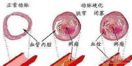 脑动脉硬化症状治疗 动脉硬化的早期症状 这是治疗动脉硬化最简单的小方子，早期患者服用，好处不言而喻