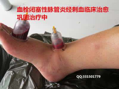 三棱针刺血疗法 三棱针刺血疗法 王氏三棱针刺血疗法治疗膈肌痉挛