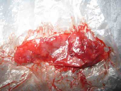 自然流产大出血 自然流产大出血 自然流产后出血多久正常？