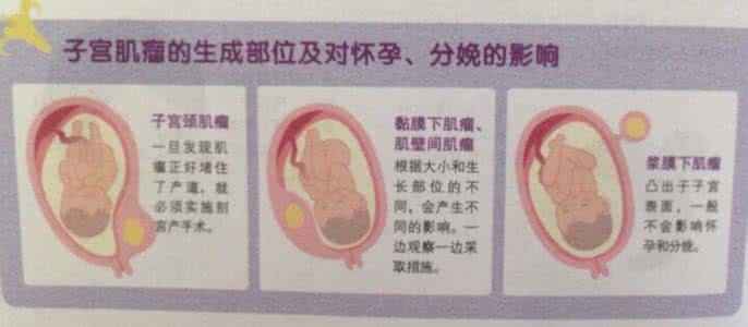 子宫肌瘤影响怀孕 子宫肌瘤影响怀孕 子宫肌瘤怎么形成的 子宫肌瘤影响怀孕吗