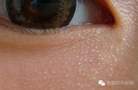 怎样祛除脸上的脂肪粒 脂肪粒可真烦人 6招祛除这些脂肪粒