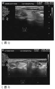 彩色多普勒超声 二维超声联合彩色多普勒超声对甲状腺癌的诊断价值