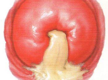 慢性子宫颈炎 宫颈炎 子宫颈炎