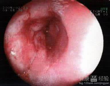单一治疗食道癌秘方 食道癌能治愈吗 12天治愈食道癌秘方