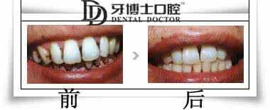 牙齿矫正多大岁数好 牙齿矫正多大岁数好 怎么看牙知道狗的岁数