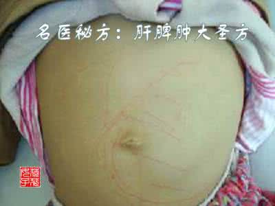 肝脾肿大 名医秘方:肝脾肿大圣方