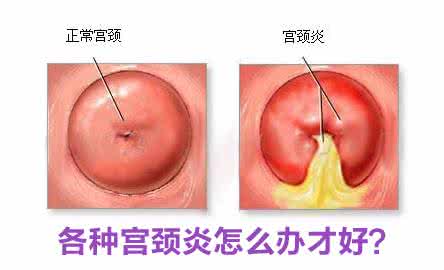 宫颈炎并发症 宫颈炎怎么造成的 宫颈炎的并发症说明