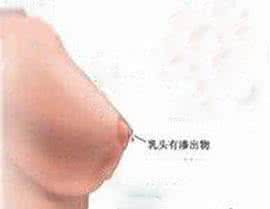 乳腺炎的症状及图片 乳腺炎的早期症状