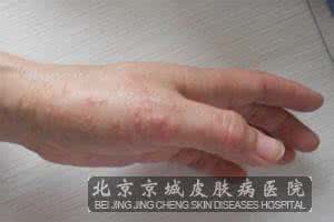 湿疹的症状与治疗 治疗湿疹的症状 湿疹的症状与治疗