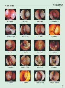 鼻窦炎中药能治愈吗 两剂中药治愈十几年的鼻窦炎