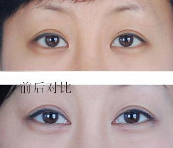开眼角一般多少钱 开眼角多少钱 开眼角一般多少钱