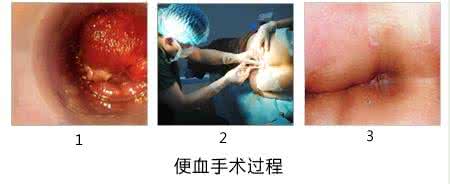 痔疮一直出血是癌变吗 痔疮出血是怎么回事