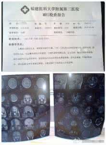 核磁共振检查 副作用 核磁共振检查什么 具体作用有哪些