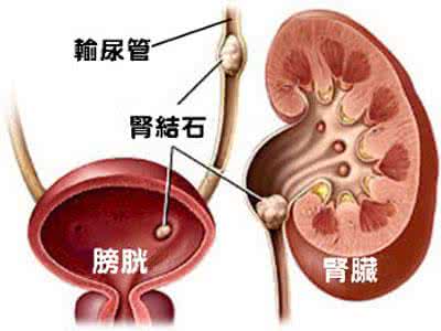 肾结石发烧怎么办 肾结石发烧 肾结石还发烧怎么办?