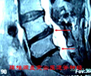 腰椎间盘突出秘方 腰椎间盘突出特效方_(绝对秘方)