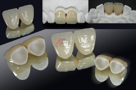 烤瓷牙二氧化锆 二氧化锆烤瓷牙 什么烤瓷牙最好