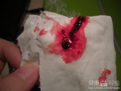 月经带血块怎么回事 月经带血块怎么回事 女性月经带血块是怎么回事