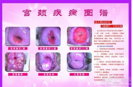 宫颈有病毒呈阳性 宫颈有病毒呈阳性 宫颈有病毒怎么办?