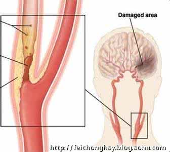 颈部动脉斑块形成 六七成脑中风源起颈部动脉