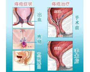 痔疮犯了能运动吗 一到月经期就犯痔疮 月经期运动 不要犯这4个错