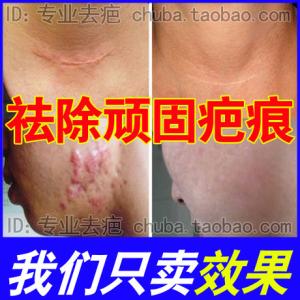 特效疤痕 疤痕灵特效膏配制方---有兴趣的可以试试