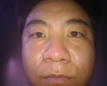 脂溢性皮炎早期症状 脂溢性皮炎 脂溢性皮炎的五大早期症状