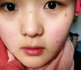 点痣后不能吃什么 点痣后牛肉是可以吃的吗