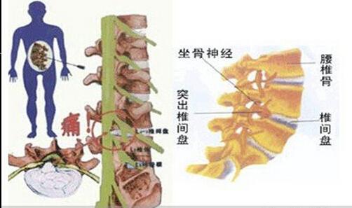 腰间盘突出治疗方法 治疗腰间盘突出方法汇集 47
