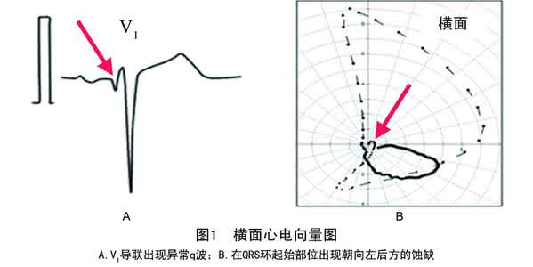 心电向量学导读及图谱 采用心电向量图分析V1、V2导联异常q波