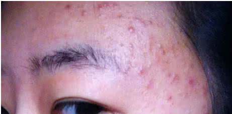 毛囊炎最佳治疗方法 毛囊炎 毛囊炎治疗