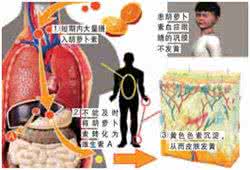 胡萝卜素血症 胡萝卜素血症 如何预防胡萝卜素血症