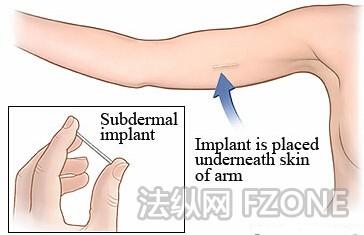 避孕贴片的副作用 避孕贴片的副作用 避孕贴片怎样用