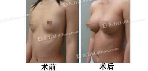 乳房下垂整形美容 乳房整形手术 乳房整形美容手术