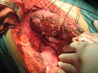 贫穷的九大癌症 癌症排行榜前五名，贫穷和富有就是一场病的距离