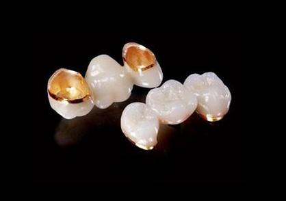 钯金贵金属烤瓷牙 贵金属烤瓷牙 黄金烤瓷牙