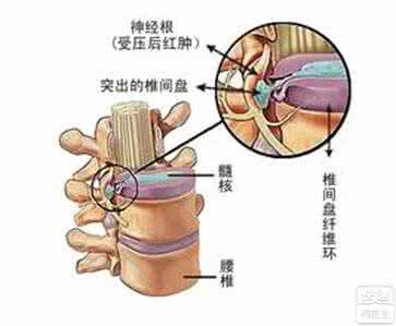 腰椎滑脱手术并发症 腰椎滑脱手术并发症 去眼袋手术的四种并发症