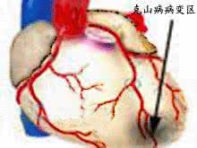 病初期症状 克山病