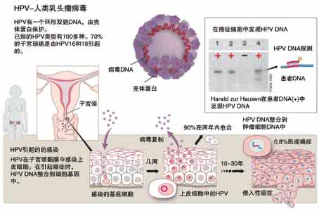 hpv阴性会得宫颈癌吗 宫颈癌hpv检查 女人一生7次HPV检查远离宫颈癌