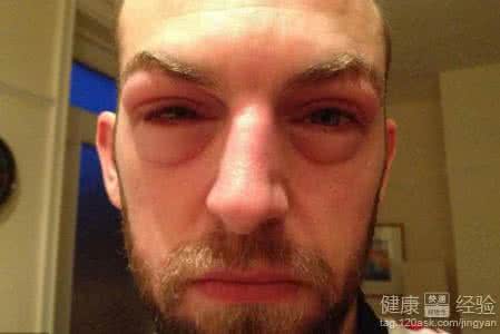 一只眼皮肿是肾病吗 眼皮肿多见肾病 盘点身上肿预示什么病?